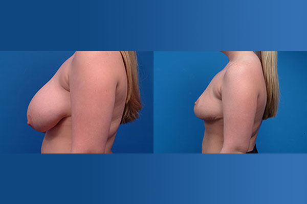 blakemore breast reduction 2