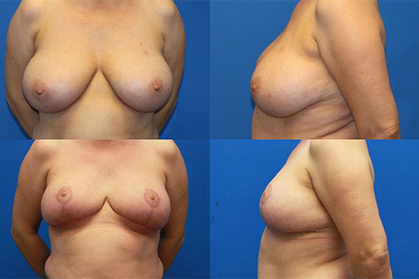 blakemore breast reduction 3