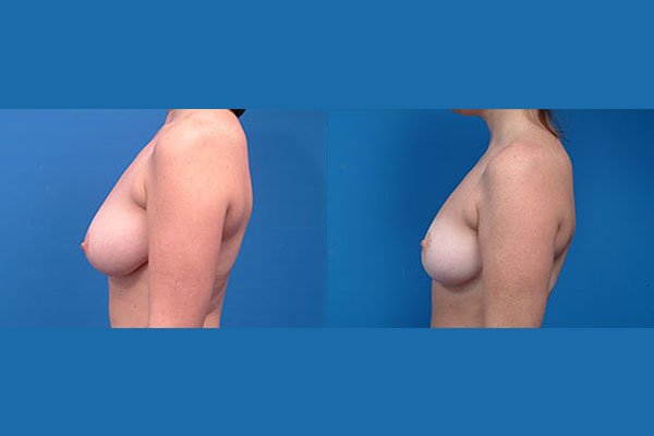 blakemore breast reduction 6