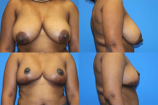 blakemore breast reduction 7