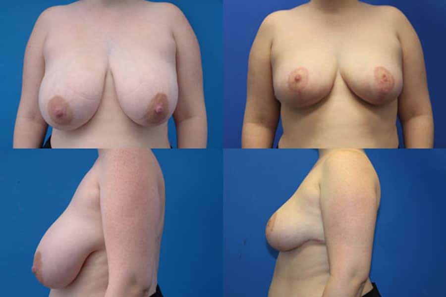 lovett Breast Reduction