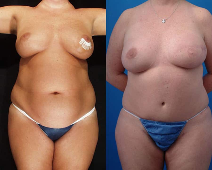 lovett Unilateral Breast Reconstruction with TRAM Flap 2