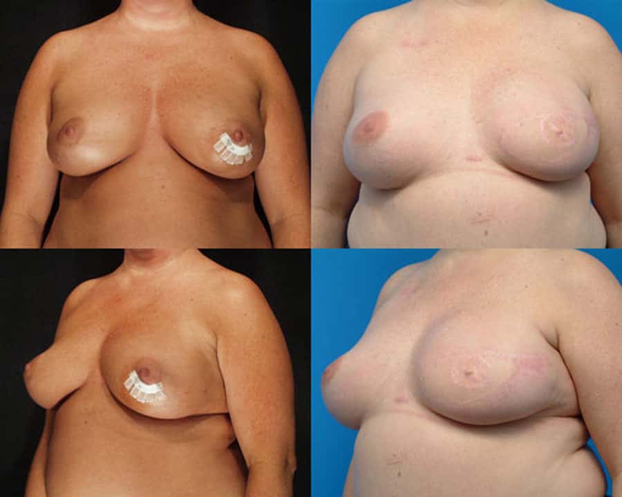 lovett Unilateral Breast Reconstruction with TRAM Flap