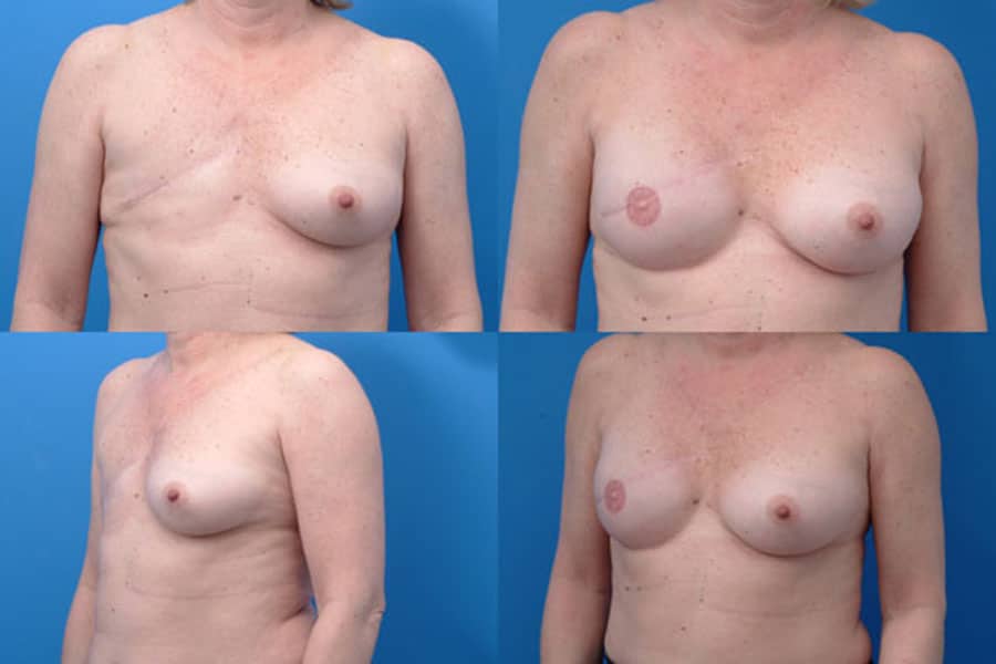 lovett Unilateral Breast Reconstruction